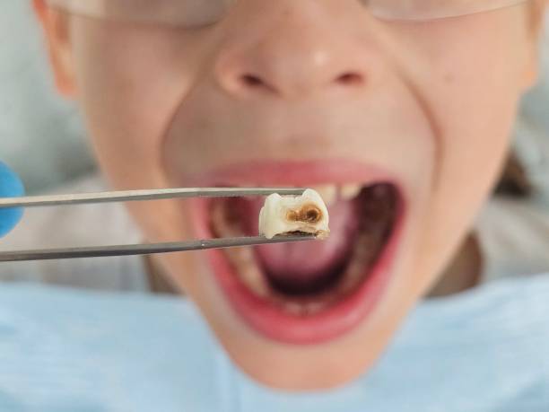 Best Emergency Tooth Extraction  in Brandon, SD